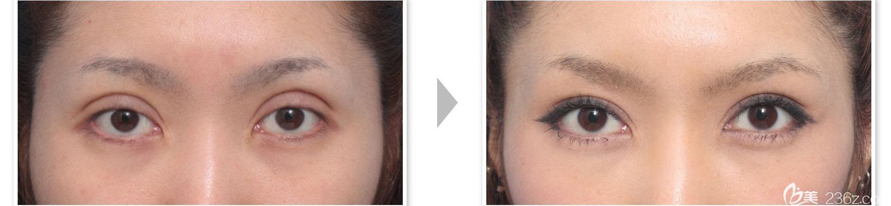 雙眼皮過寬前后對比效果