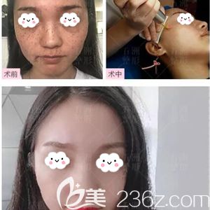 黃媛媛做激光祛斑術(shù)前術(shù)后對比案例