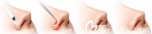 鼻綜合整形術(shù)改善蒜頭鼻過程