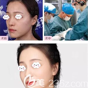 周旭剛做鼻綜合整形術(shù)后60天鼻子自然挺拔