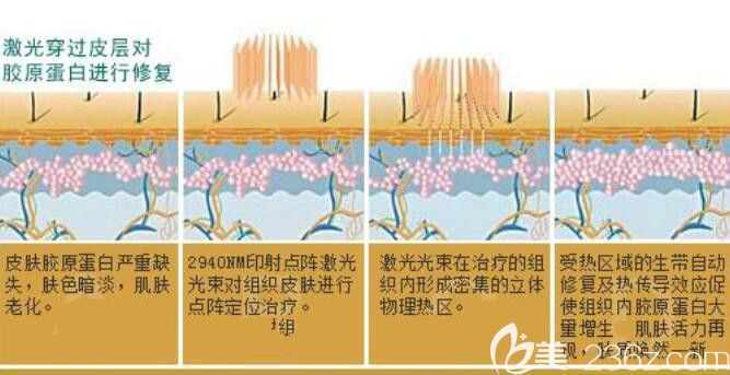 點(diǎn)陣激光祛痘坑原理介紹