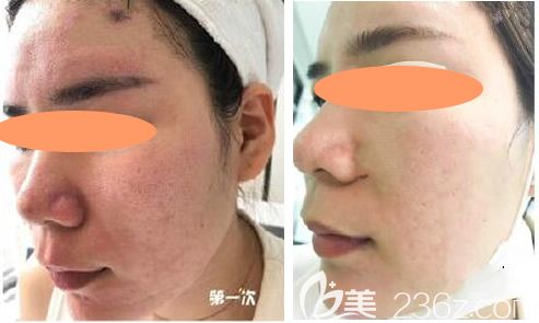 5次點(diǎn)陣激光祛痘坑效果圖