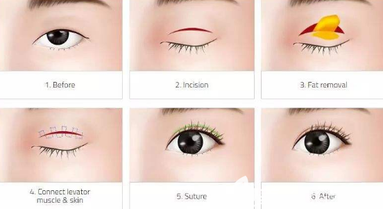 全切雙眼皮示意圖