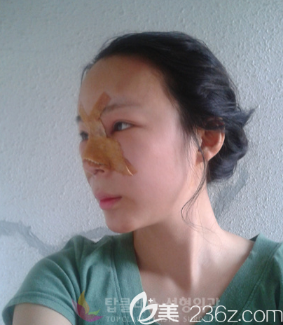 韓國TOPCLASS立體輪廓隆鼻真人案例