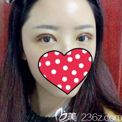 閨蜜到贛州薇琳做全切雙眼皮術(shù)后第3天