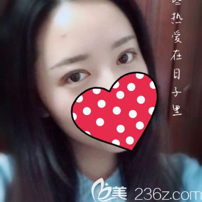 閨蜜到贛州薇琳做全切雙眼皮術(shù)后第15天效果