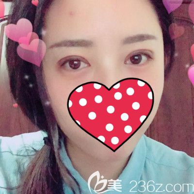 看閨蜜到贛州薇琳醫(yī)療美容割雙眼皮術(shù)后20天效果怎么樣