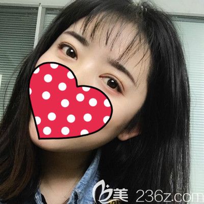 驚呆了!閨蜜到贛州薇琳做全切雙眼皮40天后簡直像換了一張臉