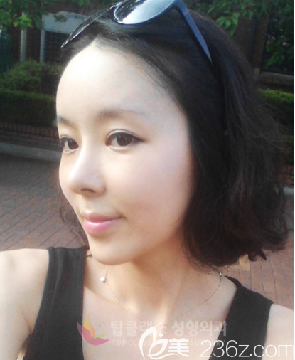 韓國TOPCLASS立體輪廓隆鼻原來是隆鼻+脂肪填充別說效果真的好