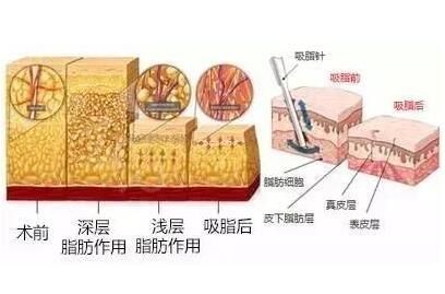 脂肪在人體存在的位置