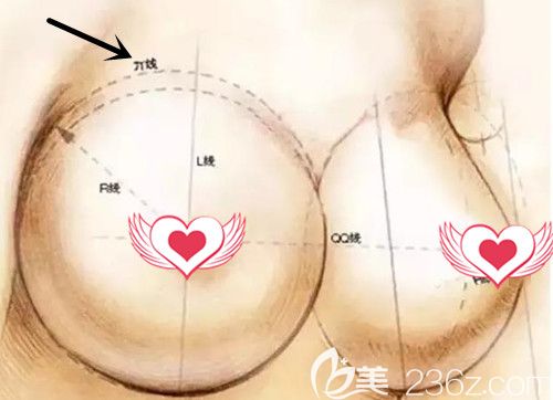 假體隆胸的大小由胸廓寬度決定