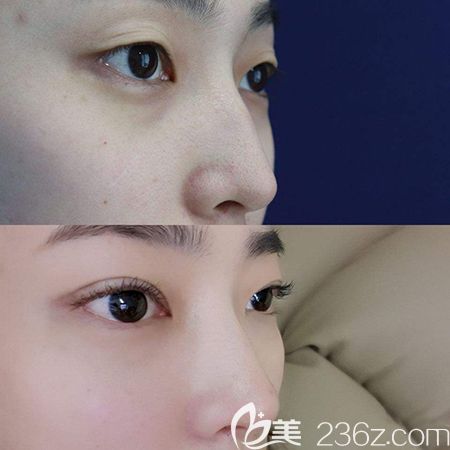 肋軟骨隆鼻術后效果對比