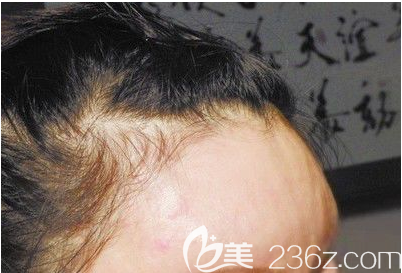 面部自體脂肪填充過量