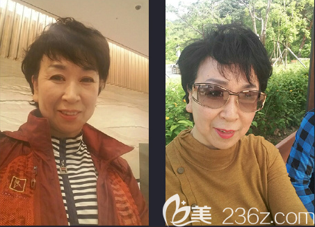 顴脂墊下移 顴脂墊下移