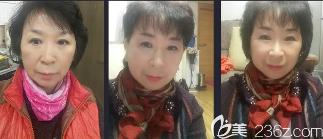 韓國JJ洪鎮(zhèn)柱面中部提升術(shù)怎么樣 韓國JJ洪鎮(zhèn)柱面中部提升術(shù)怎么樣