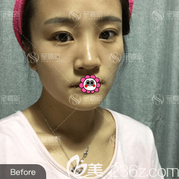 我在北京圣嘉新做自體脂肪面部填充前樣子 我在北京圣嘉新做自體脂肪面部填充前樣子