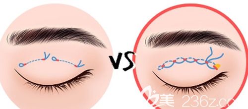 韓國(guó)原辰埋線雙眼皮手術(shù)
