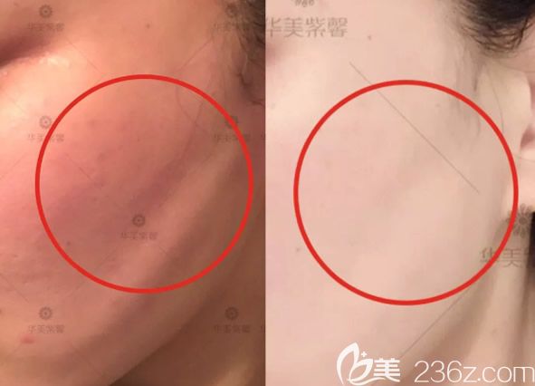 線雕后臉頰凹陷修復(fù)效果怎么樣