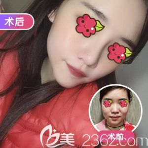 汪福強(qiáng)院長(zhǎng)做韓式生科假體隆鼻術(shù)前術(shù)后對(duì)比