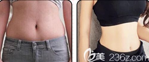 汪洋醫(yī)生做腰腹吸脂術(shù)后30天腰部明顯變細(xì)