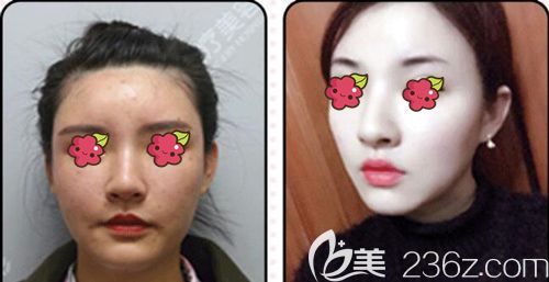 項(xiàng)利姣院長(zhǎng)做自體脂肪面部填充術(shù)后面部輪廓線變明顯