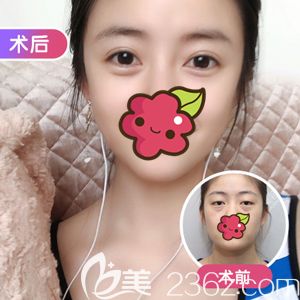 做無(wú)痕精雕雙眼皮選擇項(xiàng)利姣醫(yī)生