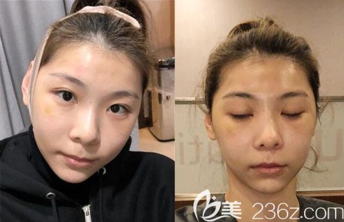 韓國顴骨內(nèi)推術(shù)后1周恢復(fù)圖片 韓國顴骨內(nèi)推術(shù)后1周恢復(fù)圖片