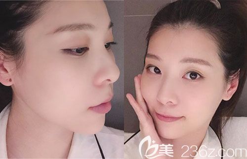 不知顴骨內(nèi)推后頭套戴多久參考我找韓國那木整形醫(yī)院用可溶釘做秘密顴骨縮小術(shù)案例