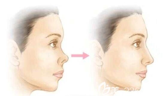 朝天鼻整容前后蛻變