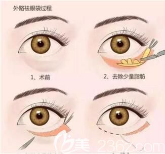 外路祛眼袋方法示意圖