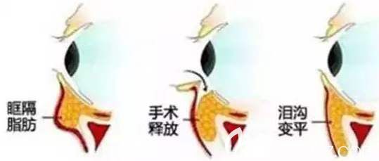 祛除淚溝示意圖