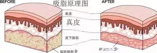 吸脂瘦手臂原理