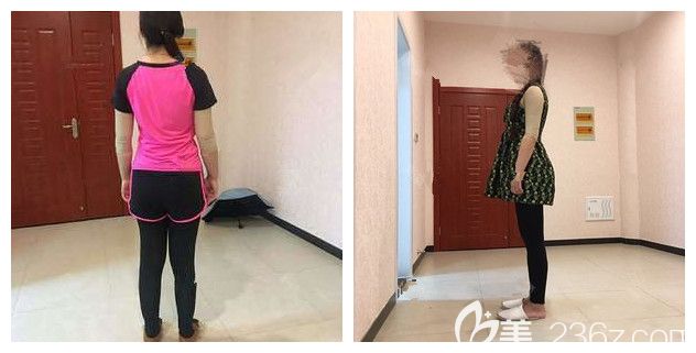 術(shù)后一個(gè)月穿著塑身衣的手臂