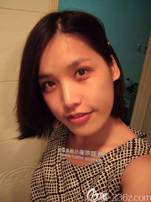 韓國奧納比雙眼皮真人案例