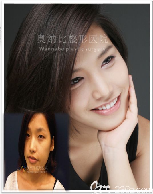 韓國奧納比雙眼皮真人案例