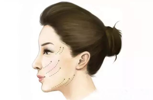 面部埋線提升原理介紹