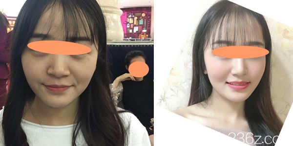 【真實案例】全面部埋線提升前后對比圖