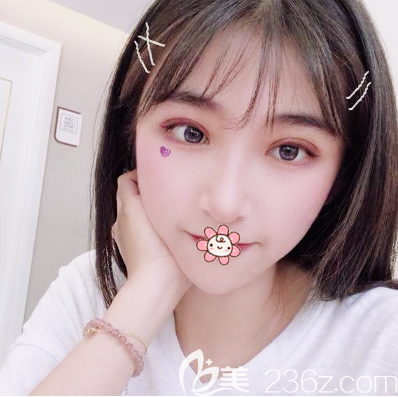 看朋友找佛山華美梁宗建院長做的雙眼皮效果那么自然我也忍不住去做了眼綜合