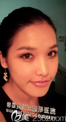 我已深深陷入韓國奧納比張哲豪做的自然粘連法雙眼皮+開內(nèi)眼角的魅力中