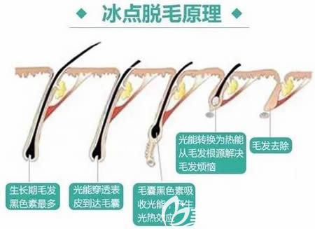 冰點脫毛原理介紹