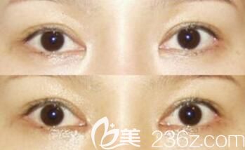 開內眼角失敗修復術前術后對比照
