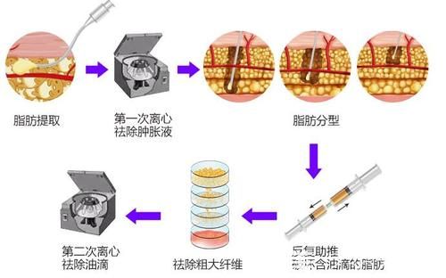 自體脂肪提取流程示意圖