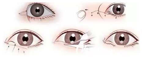 開眼角手術(shù)圖解