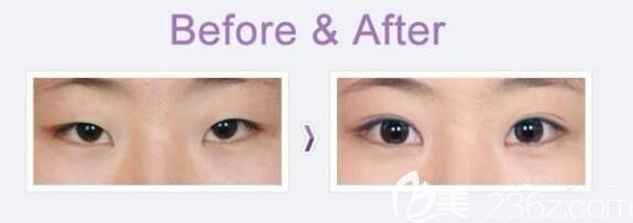 開眼角術(shù)后效果