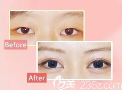 開眼角術(shù)后眼睛變大