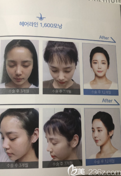 韓國NHI植發(fā)醫(yī)院案例 韓國NHI植發(fā)醫(yī)院案例