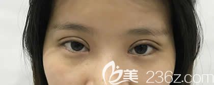 在西寧康華醫(yī)院割雙眼皮術(shù)后第5天