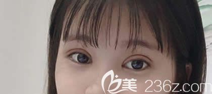 在西寧康華醫(yī)院割雙眼皮術(shù)后第10天