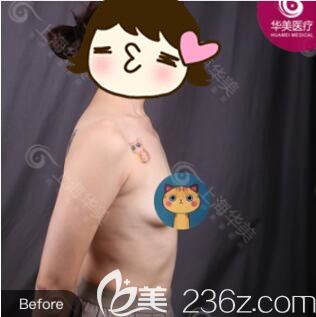 <!--<i data=20240703-sp></i>-->華美謝衛(wèi)國(guó)娜綺麗假體隆胸真人案例術(shù)前照 <!--<i data=20240703-sp></i>-->華美謝衛(wèi)國(guó)娜綺麗假體隆胸真人案例術(shù)前照