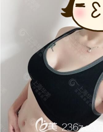 <!--<i data=20240703-sp></i>-->華美謝衛(wèi)國(guó)娜綺麗假體隆胸真人案例術(shù)后49天 <!--<i data=20240703-sp></i>-->華美謝衛(wèi)國(guó)娜綺麗假體隆胸真人案例術(shù)后49天